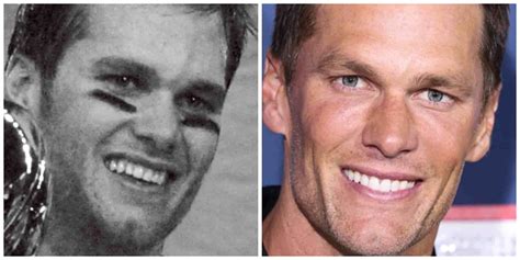 are tom brady's teeth fake